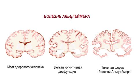 Активизация мозговой активности для предотвращения болезни Альцгеймера