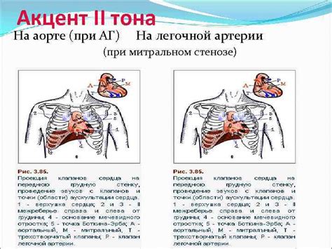 Акцент 2 тона над аортой: что это такое?