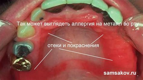 Аллергическая реакция на металл кольца