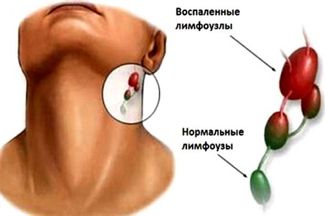 Аллергия и увеличение лимфоузлов на шее сзади