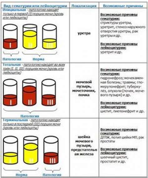 Анализ мочи для определения состава камня