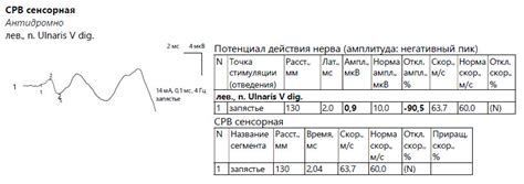 Анализ электромиографии