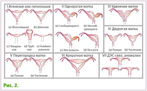 Аномалии матки