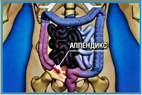 Аппендицит: симптомы и возможные причины