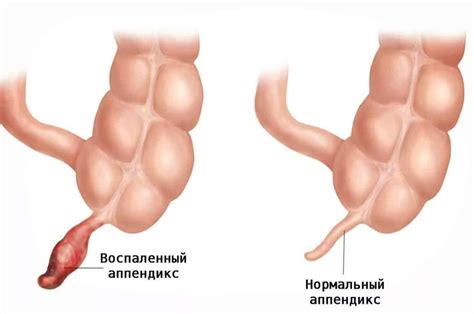 Аппендицит: симптомы и операция