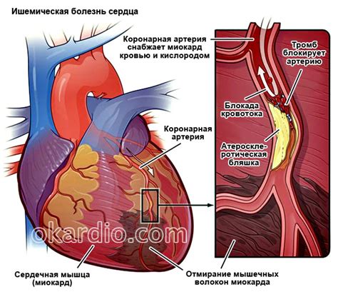 Артериосклероз и болезни сердца