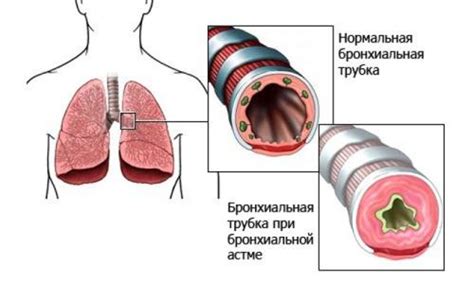 Астма и нарушение дыхания