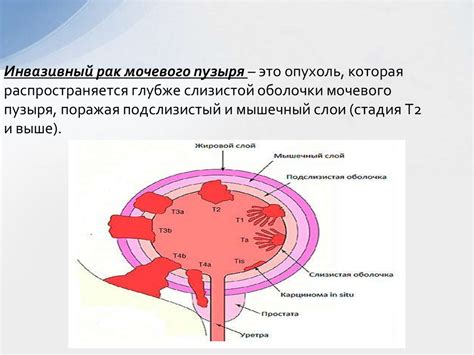 Атрофия слизистой оболочки мочевого пузыря