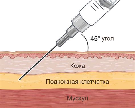 Аутогенные инъекции для выравнивания шрама