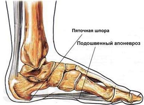 Ахиллова пяточная шпора