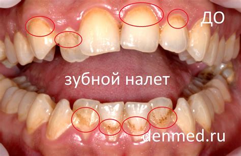 Бактерии и гниение в зубной полости