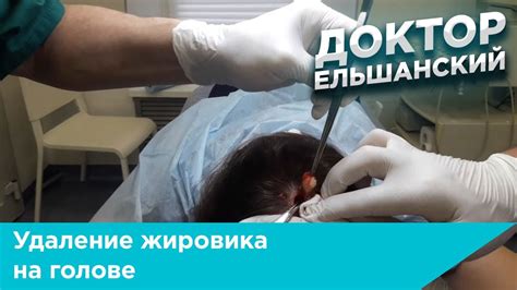 Безопасная процедура устранения жировика на голове в Самаре