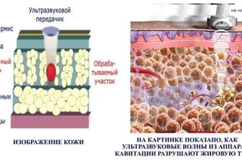 Безопасные методы избавления от жировых отложений на лице после липофилинга