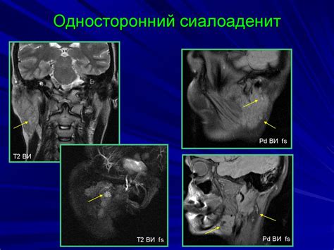 Блокирование слюнных протоков