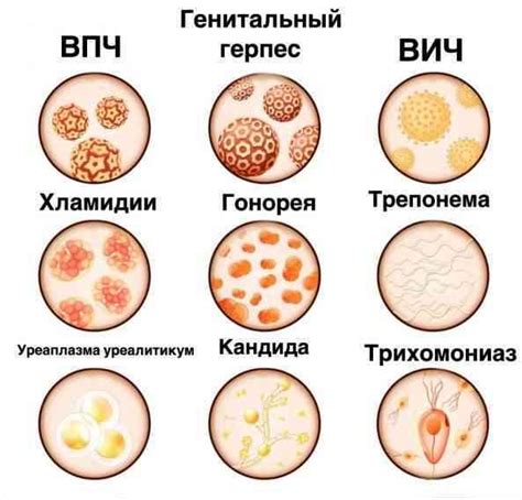 Болезни, передающиеся половым путем