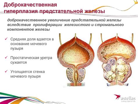 Болезни мочевой системы у мужчин