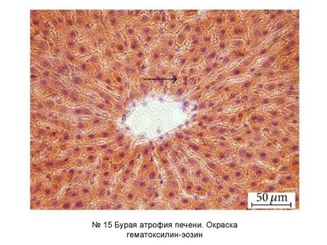 Болезнь Гилберта и другие нарушения обмена билирубина