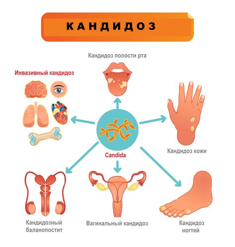 Вагинальная кандидоз