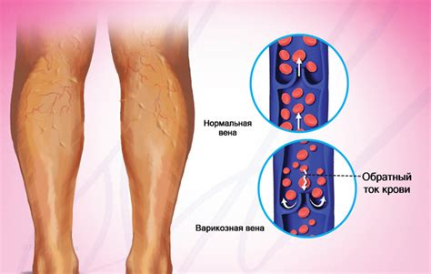 Варикозное расширение вен и болезненное синдромы