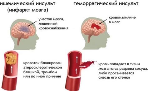 Виды икания и его симптомы