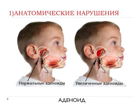 Виды и причины аденоидов