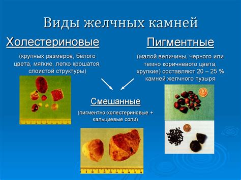 Виды камней в организме и признаки их наличия