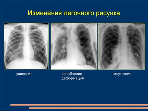 Виды патологий легочного рисунка