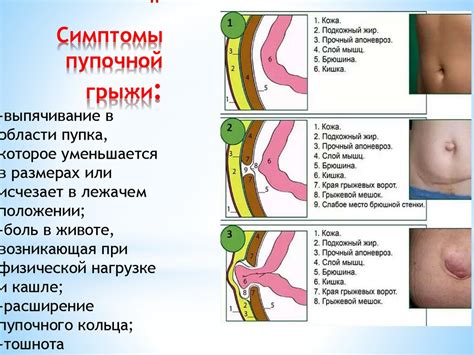 Визуальная диагностика пупочной грыжи у младенца