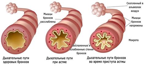 Влияние бронхиальной астмы на процесс выдоха