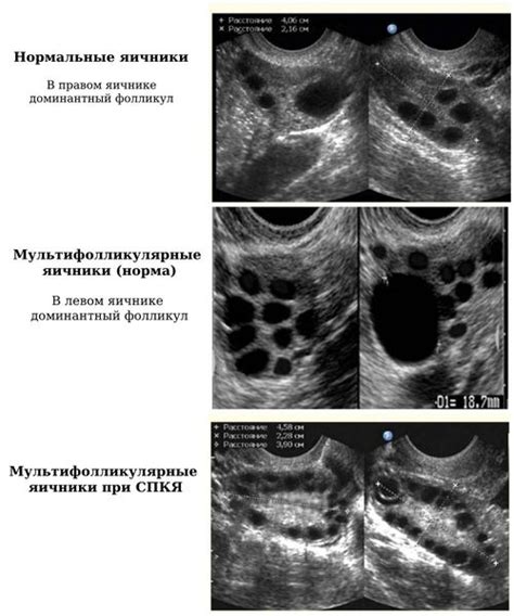 Влияние гормональных нарушений на яичники