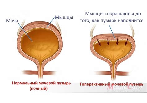 Влияние гравитации на мочевой пузырь