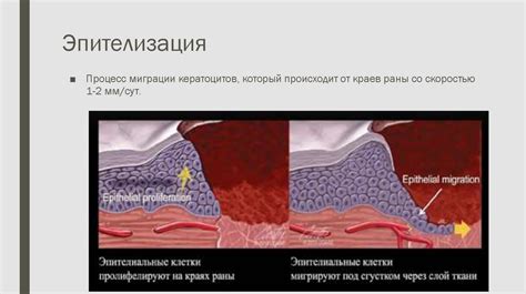 Влияние инфекций на заживление