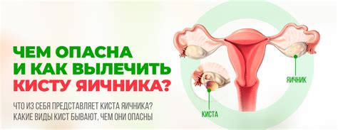 Влияние кисты яичника на организм