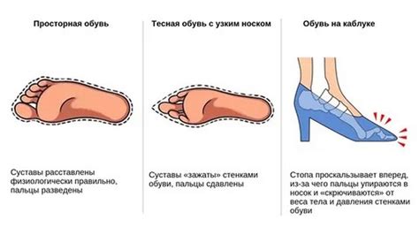 Влияние неправильного обуви на здоровье суставов