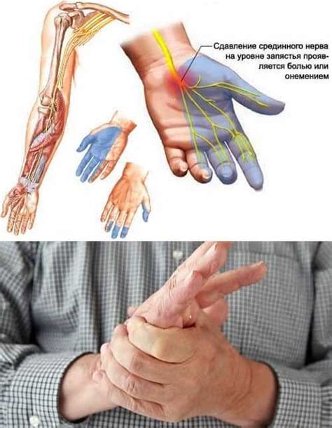 Влияние нервной системы на онемение пальца
