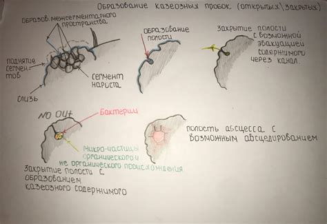 Влияние пищи на образование казеозных пробок