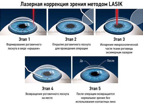 Влияние слез на результаты лазерной коррекции глаз: исследование послеоперационных слез