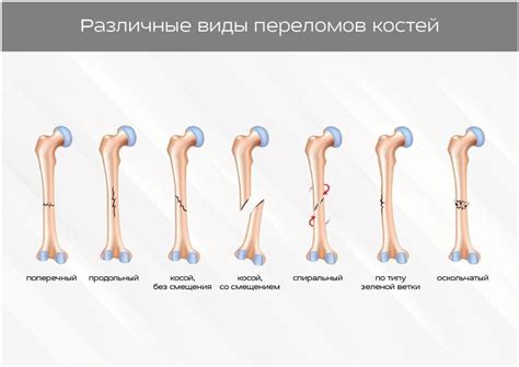 Влияние травм и переломов на рост костей