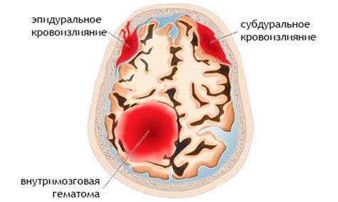 Внутренние кровоизлияния в головной мозг и их последствия