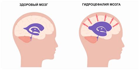 Водянка головы: что это такое и как она возникает