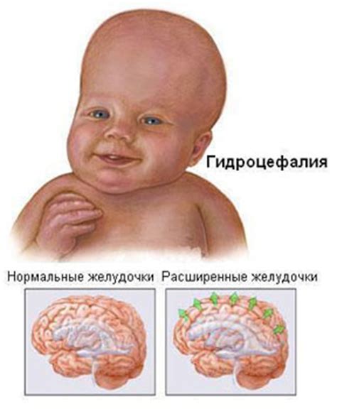 Водянка головы у ребенка: причины, симптомы и диагностика