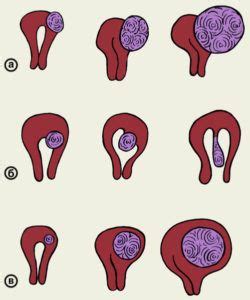 Возможное разрастание миомы