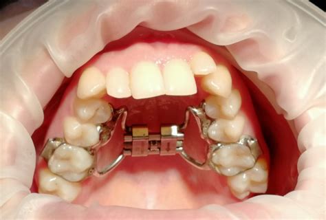 Возможности использования ретейнеров на верхней челюсти