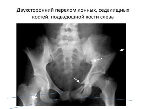 Возможность повреждения костей и органов