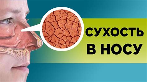 Возможные заболевания, приводящие к сухости в носу