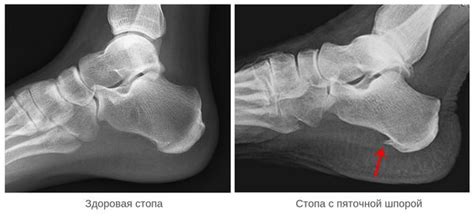 Возможные изменения на стопе с шпорой