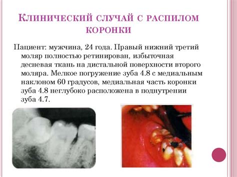 Возможные осложнения при самостоятельном удалении шипицы