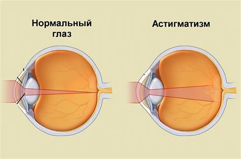 Возможные последствия и восстановление зрения