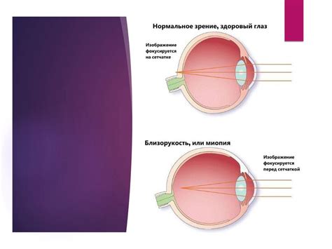 Возможные факторы, влияющие на ухудшение зрения в одном глазу