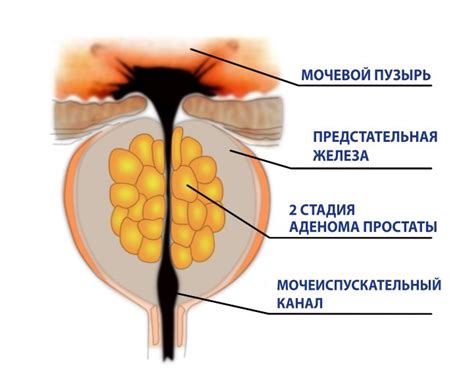 Возрастные изменения и увеличение предстательной железы